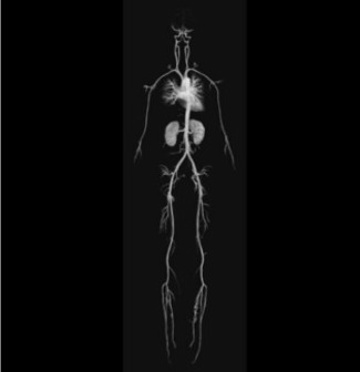 MR Angiography